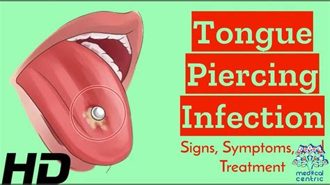 discharge from tongue piercing|How to Recognize and Treat an Infected Piercing